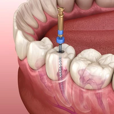 root canal therapy Fort Washington, MD
