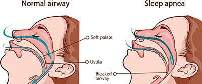 sleep apnea treatment Fort Washington, MD