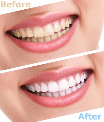 teeth whitening Fort Washington MD